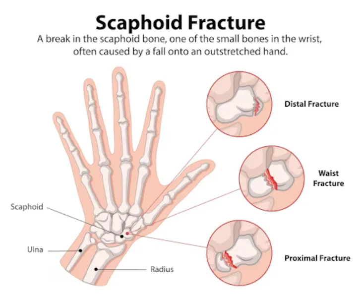 Scaphoid Fracture Surgery in Bangalore – Effective...