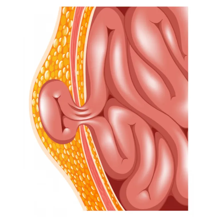 Hernia Treatment in PCMC – Minimally Invasive Hern...