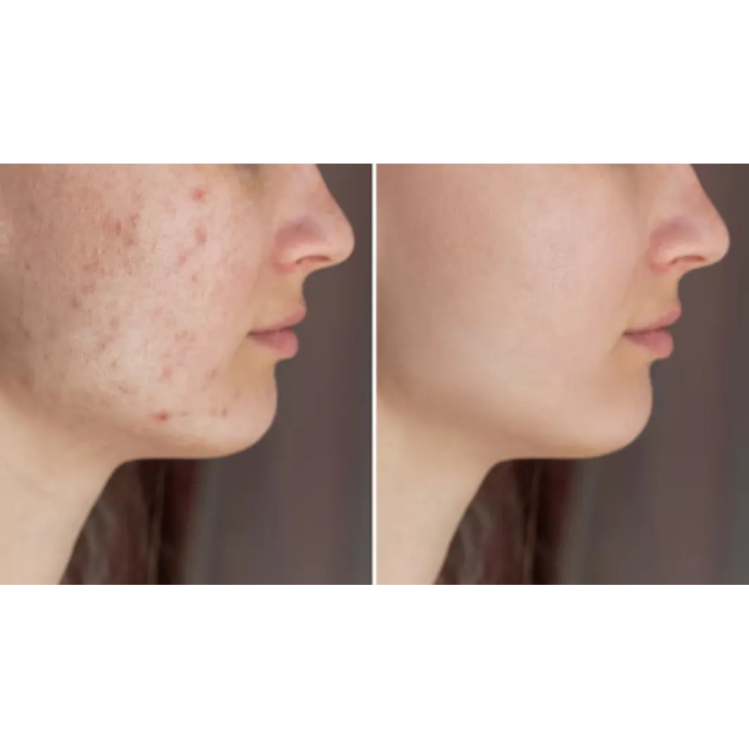 Acne Scars Treatment in Thane – Restore Smooth Ski...