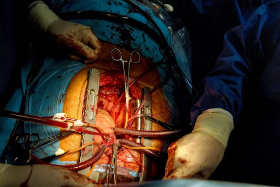 OPCAB Surgery in Nagpur – Off-Pump Heart Bypass Tr...