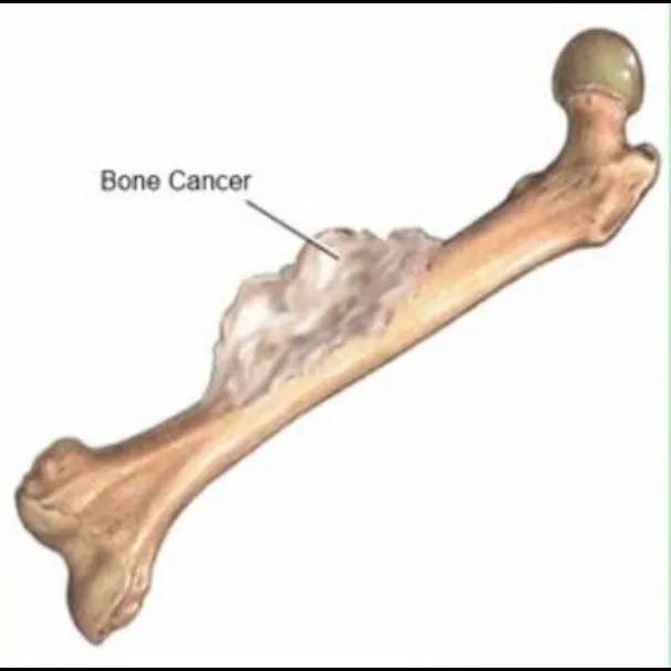 Bone Cancer Treatment in Mumbai – Know Your Option...