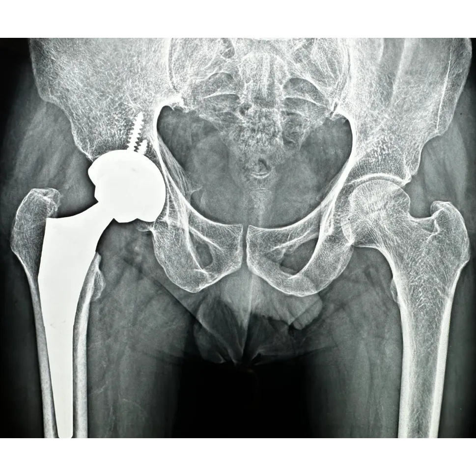 Hip Replacement in Nagpur to Restore Comfort and M...