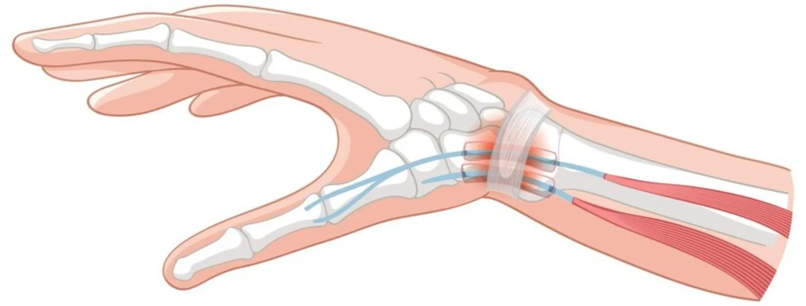 Carpal Tunnel Decompression in Bangalore – Targete...