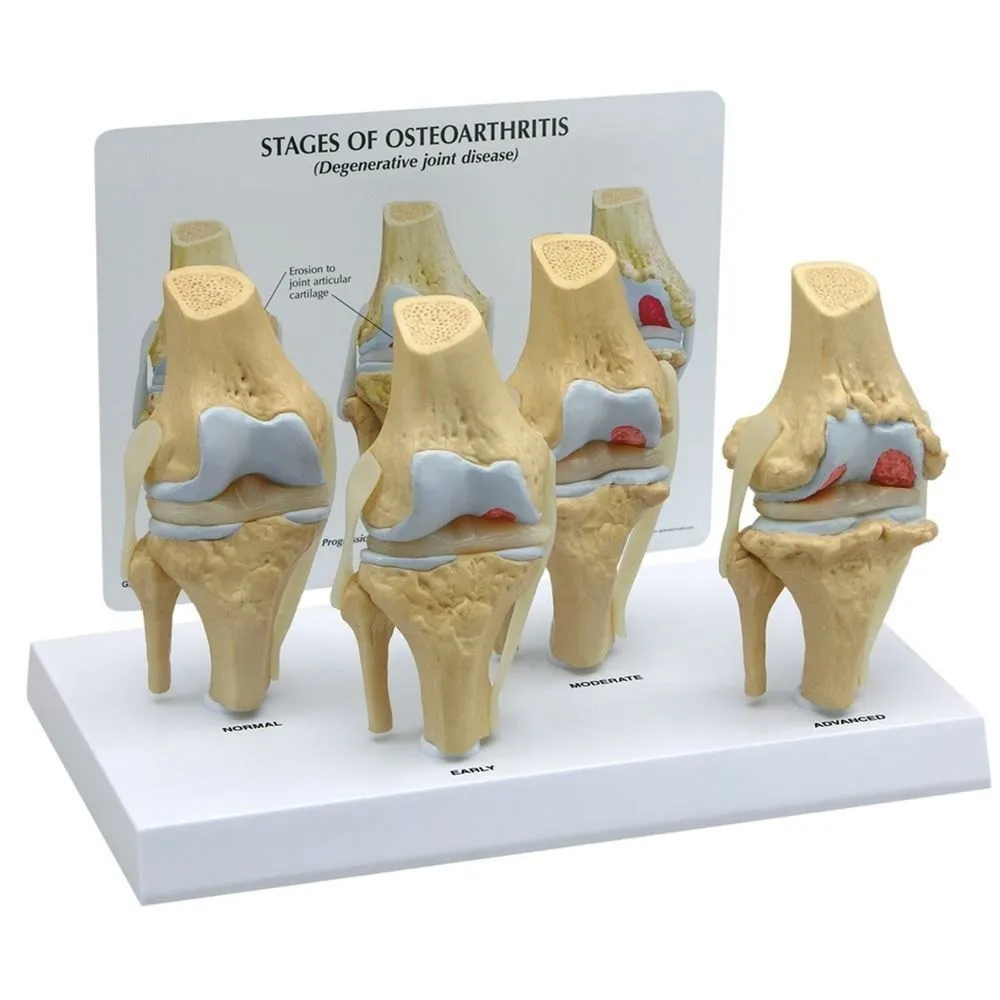 Osteoarthritis Treatment in Nagpur – Regain Mobili...