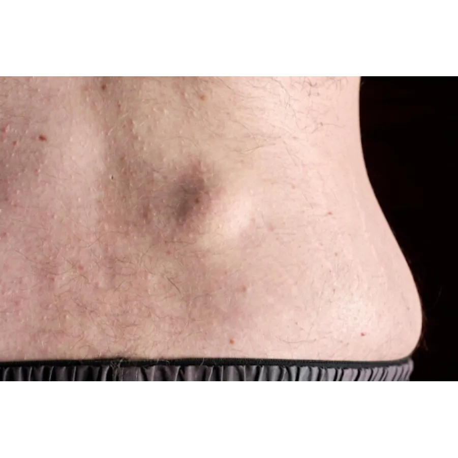 Lipoma Removal in Kurla – Simple, Safe, and Scar-M...
