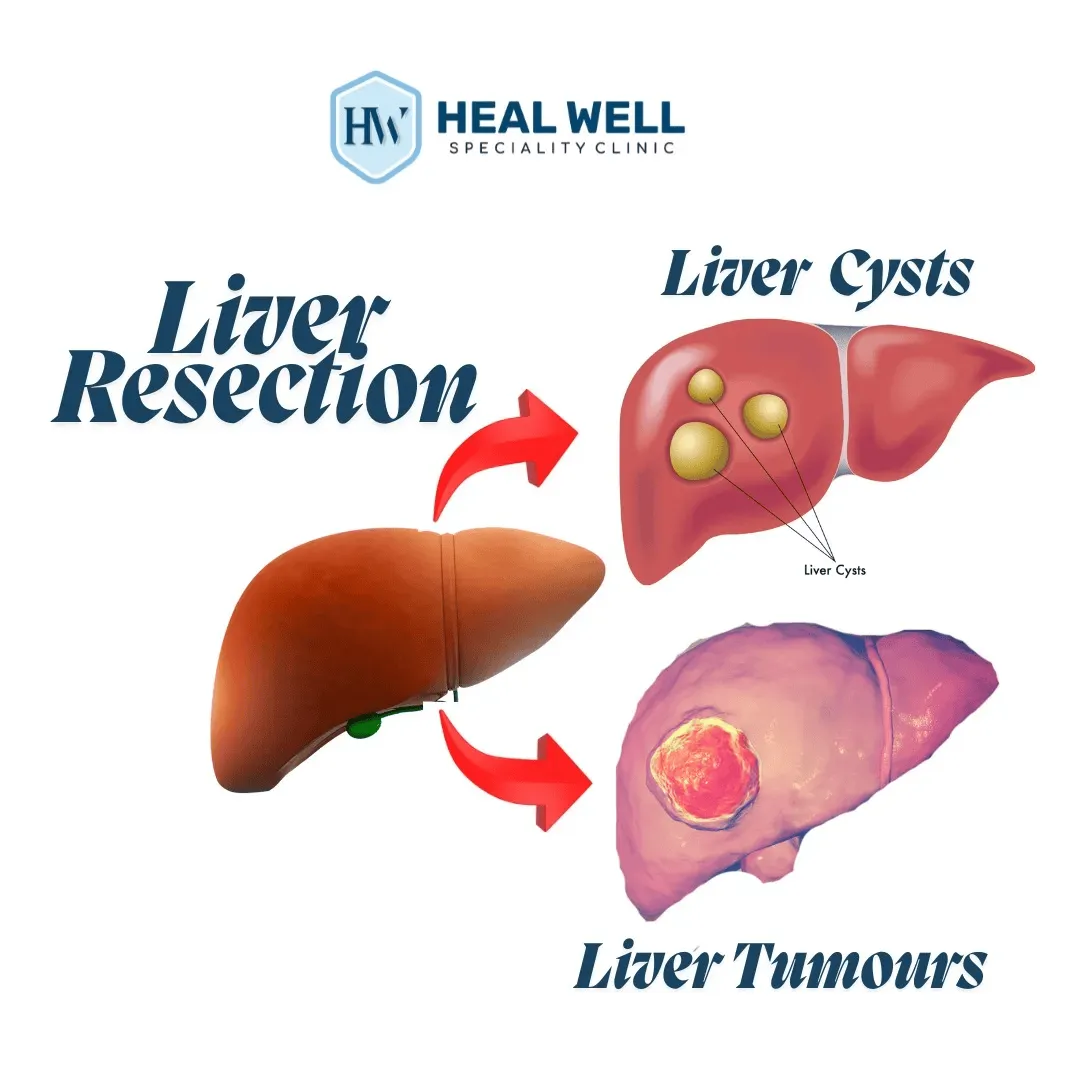 Liver Resection Surgery in Thane – Advanced Treatm...