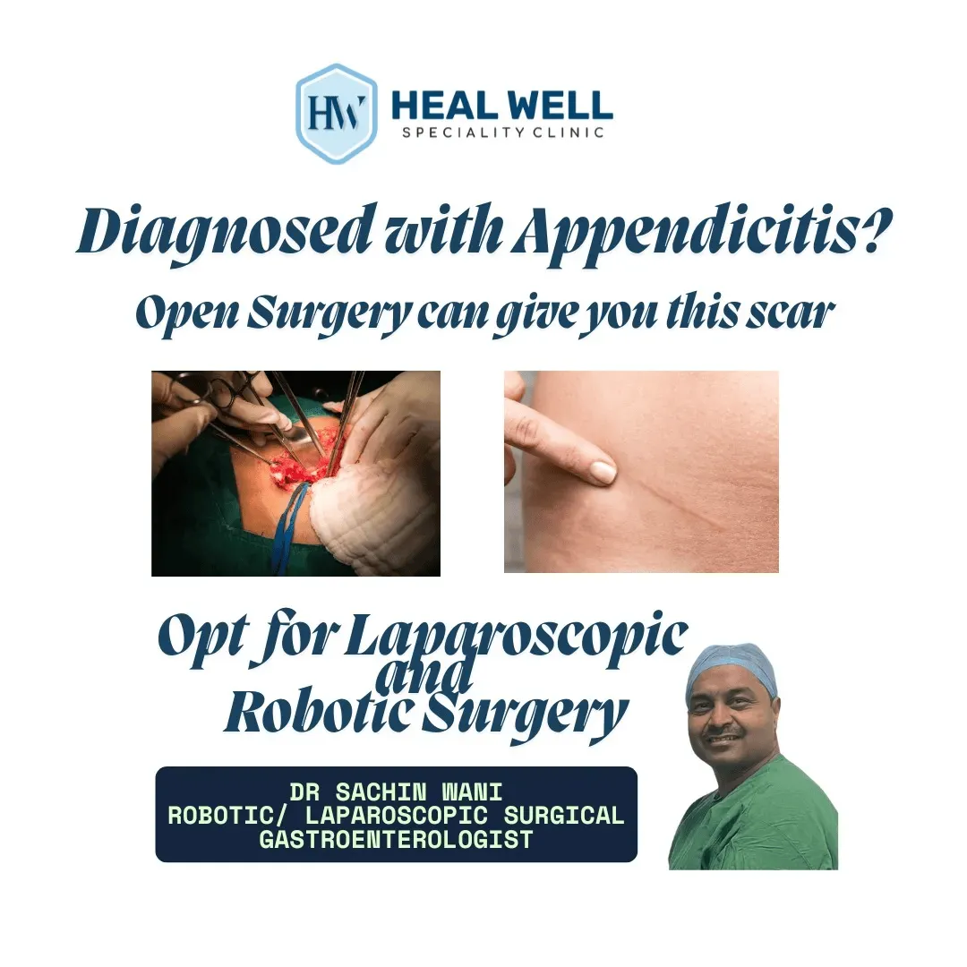 Appendicectomy in Thane – Laparoscopic and Robotic...