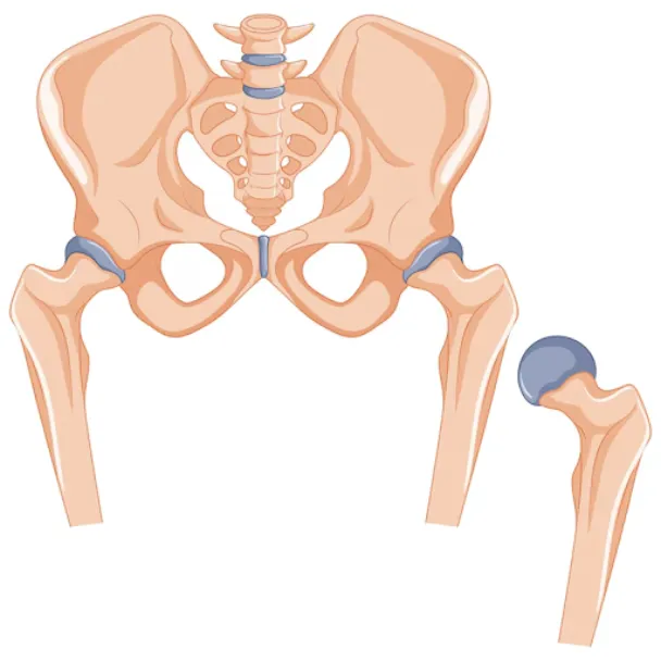 Complex Hip Replacement Procedure in Bangalore – R...