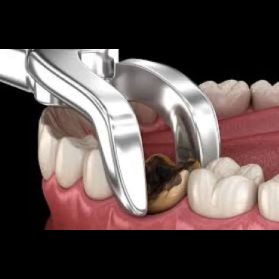 Wisdom Tooth Extraction in Greater Noida West | Sa...
