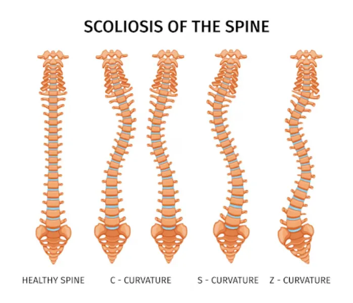 Scoliosis Specialist in Nagpur – Effective Spine T...