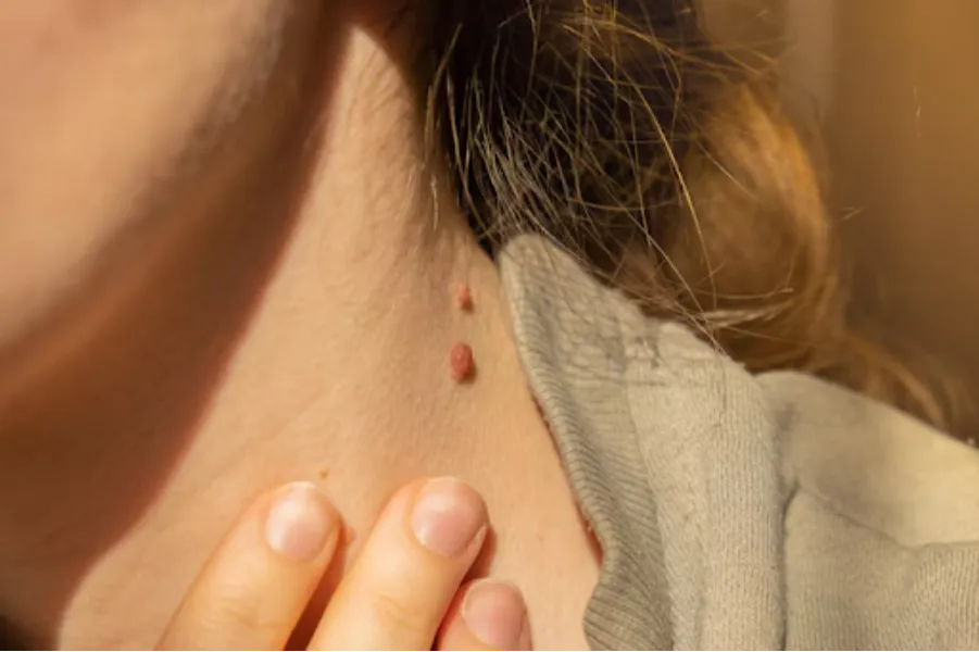 Skin Tags Treatment in Kolshet Road – Remove Unwan...
