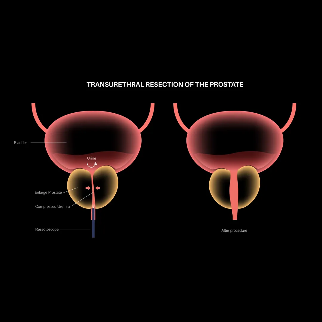 TURP Prostate Surgery Experts in Kamgar Nagar-Than...