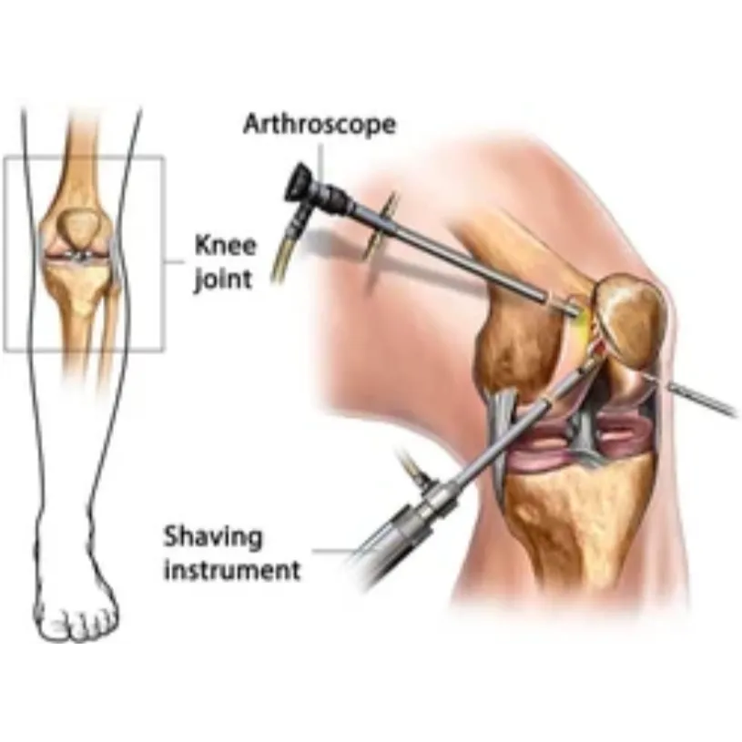 Arthroscopic ACL Reconstruction in Bangalore – Adv...