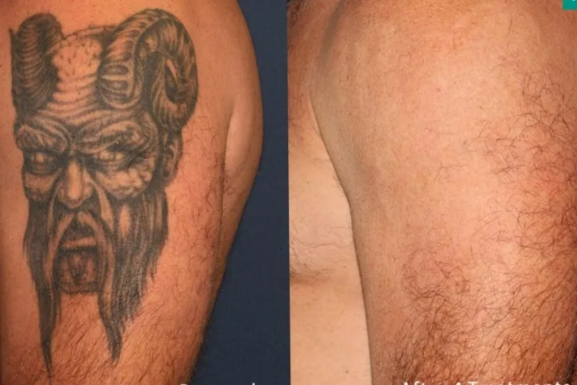 Tattoo Removal in Uttam Nagar Tattoo Removal Offer...