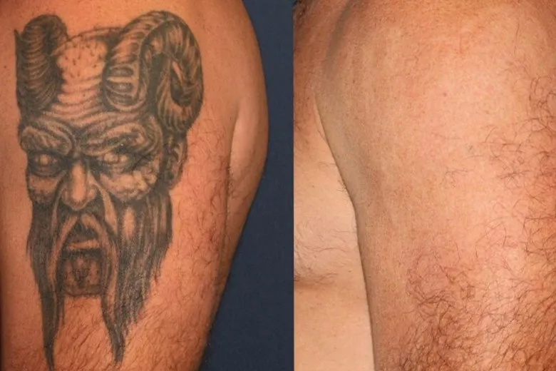Tattoo Removal Offering Tattoo Removal in Uttam Na...
