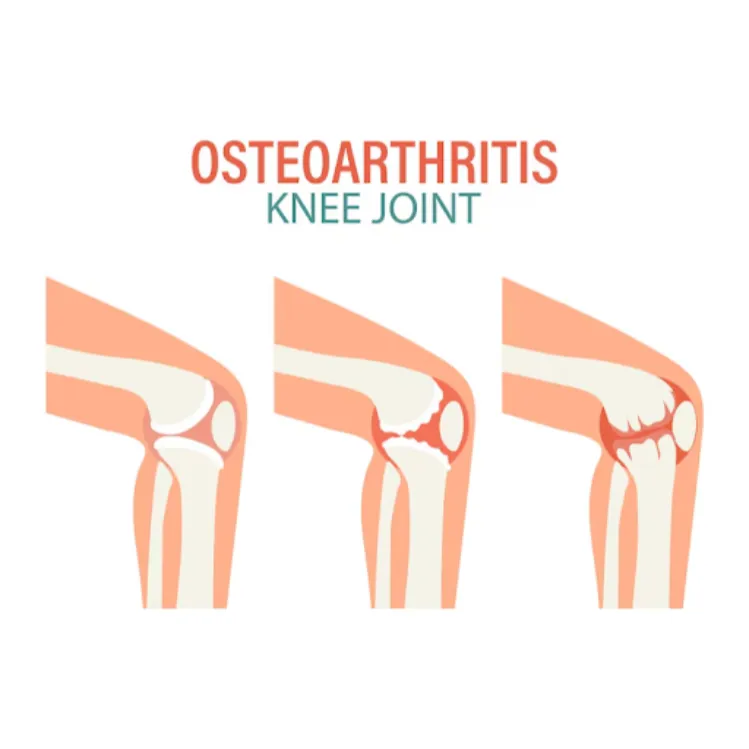 Osteoarthritis Treatment in ECR – Holistic Support...