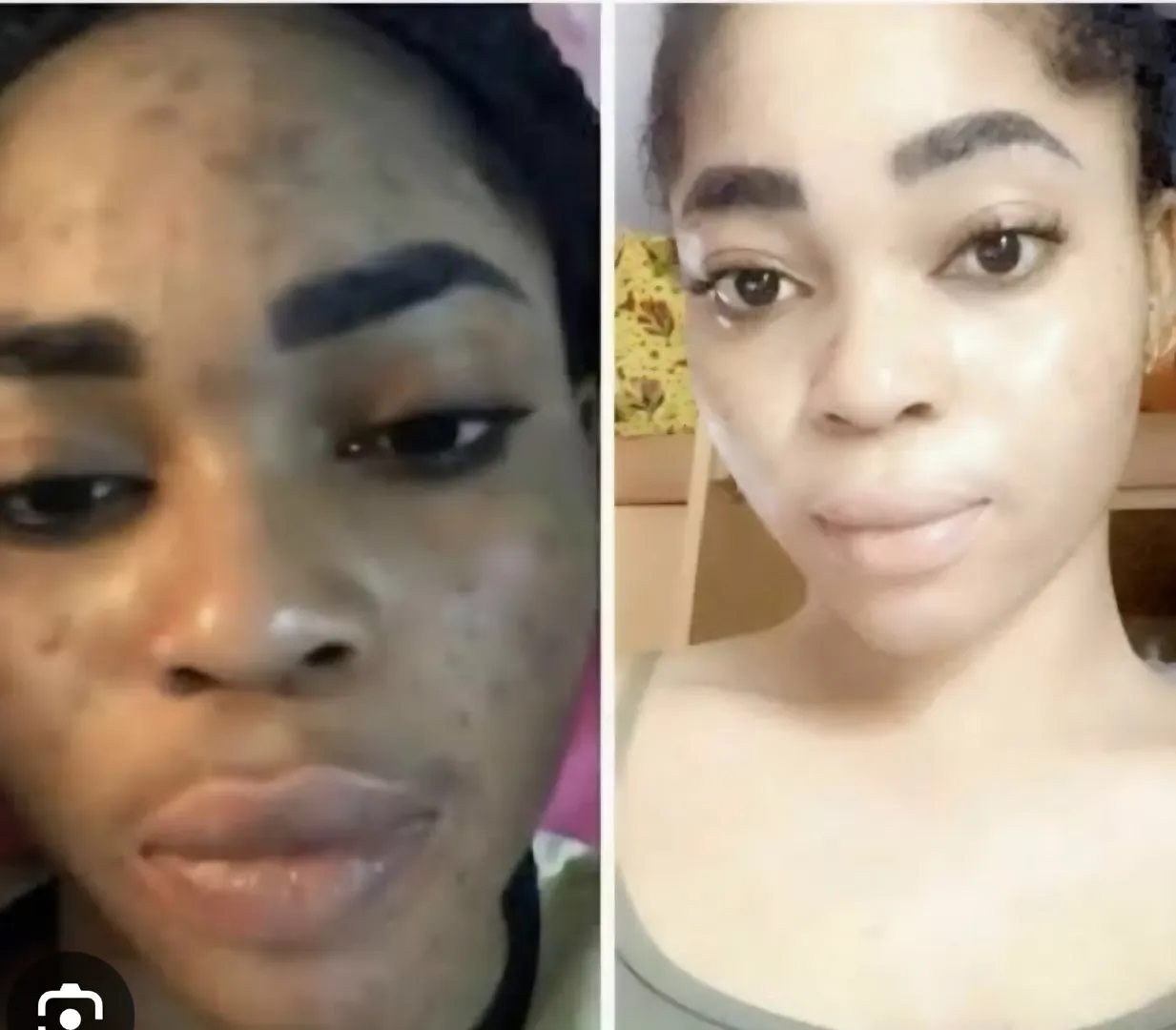 🧪 Top Treatments for Skin Lightening 1. Chemical P...