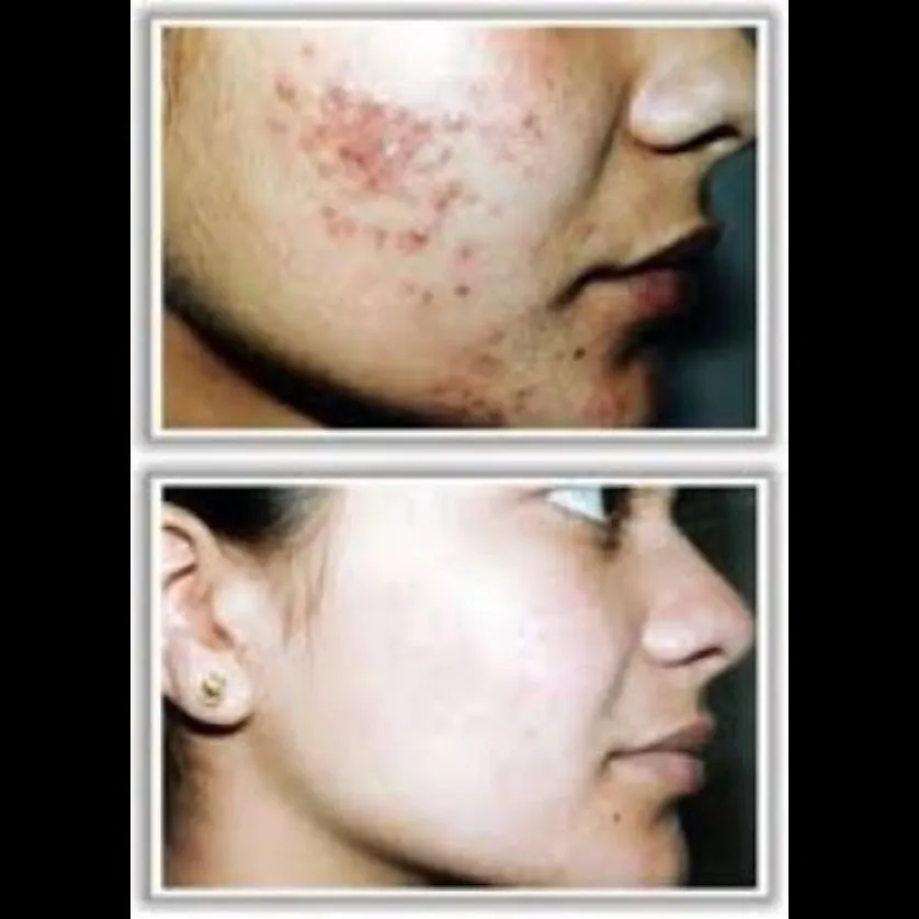 Acne Vulgaris Treatment in Dhule | Expert Dermatol...