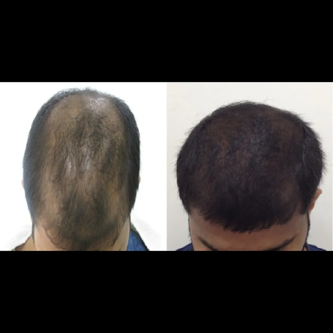 How long do the effects of PRP treatment for hair ...