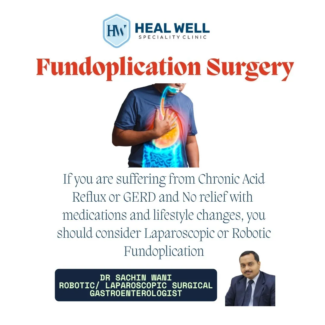 Fundoplication Surgery in Thane – Lasting Relief f...