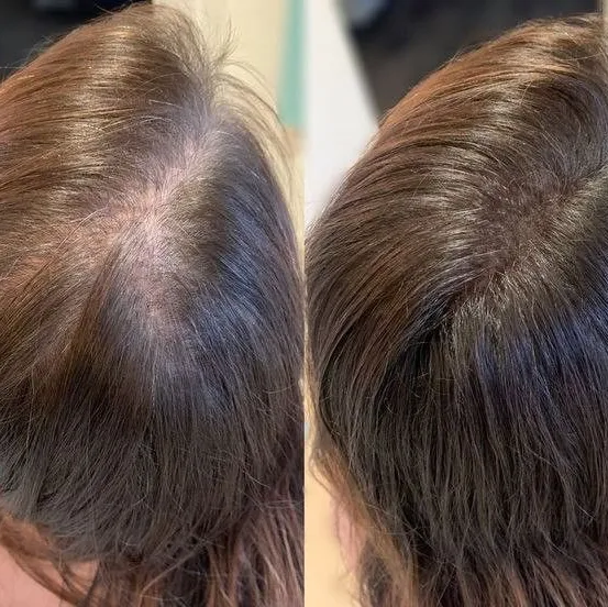 hair GFC PRP
boost your scalp with plasma therapy ...