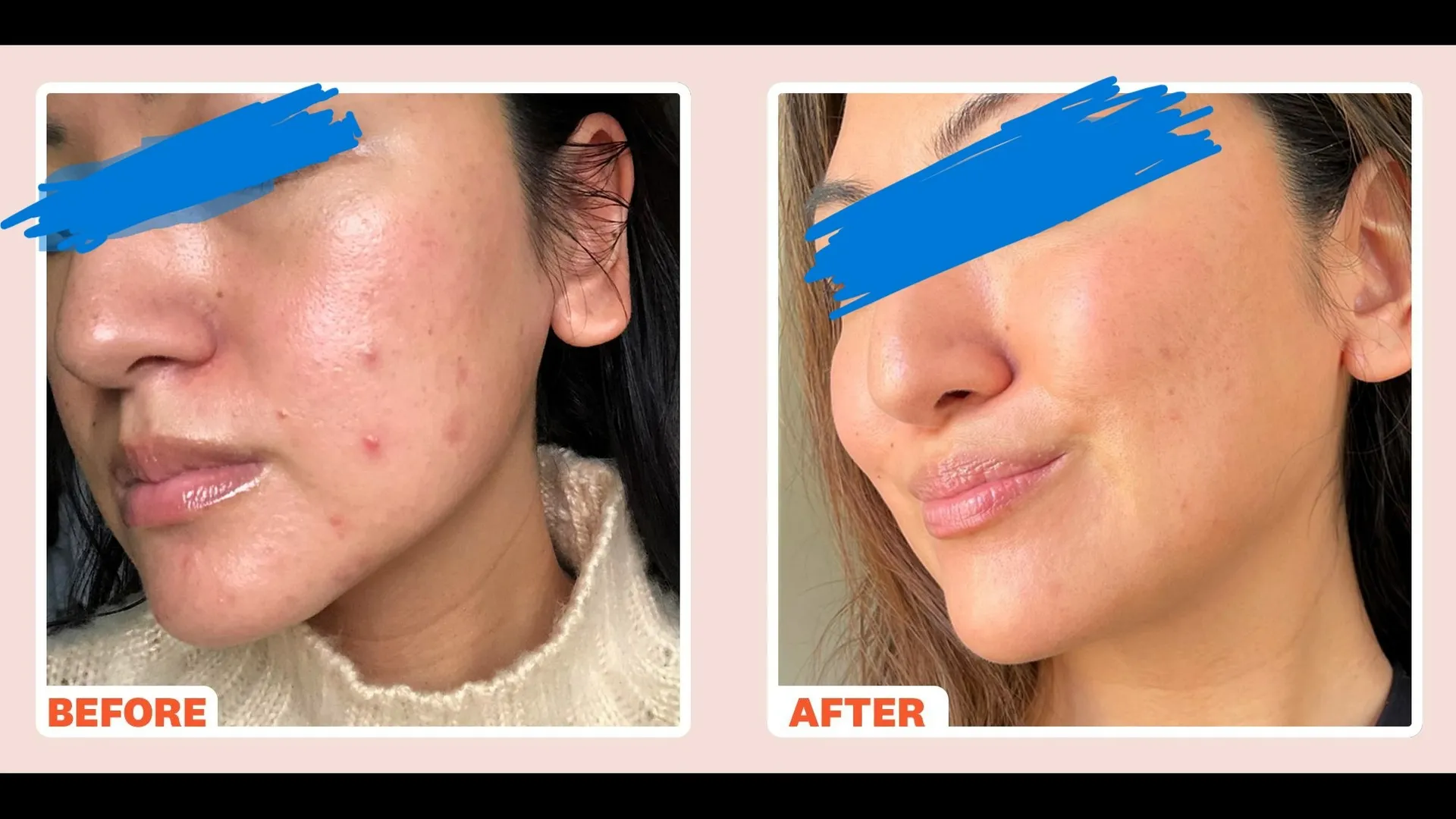 π MNRF: Transform Skin, Fade Scars π
Still struggl...