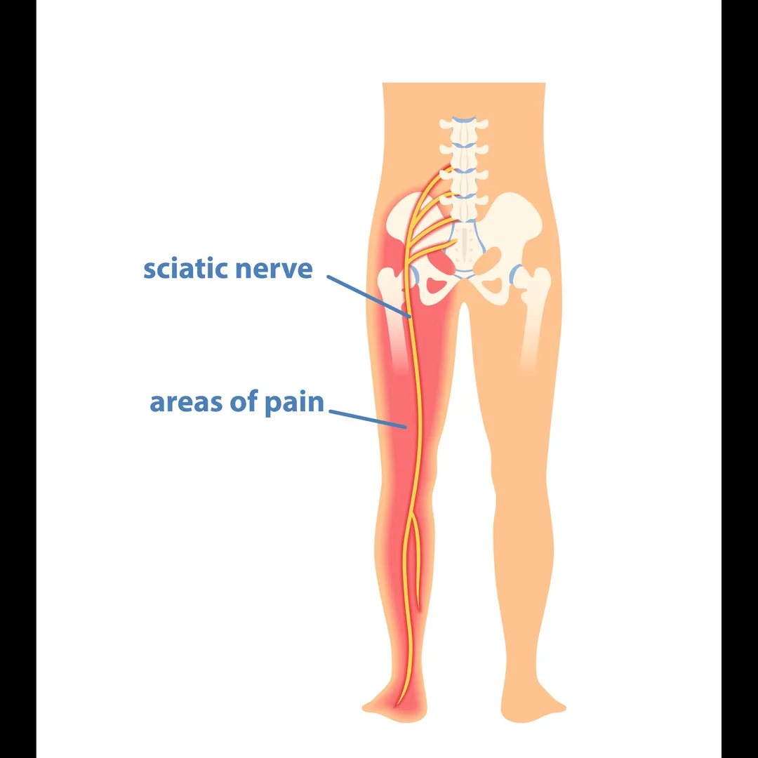 Sciatica Orthopedic Doctor in Nagpur – Find Lastin...