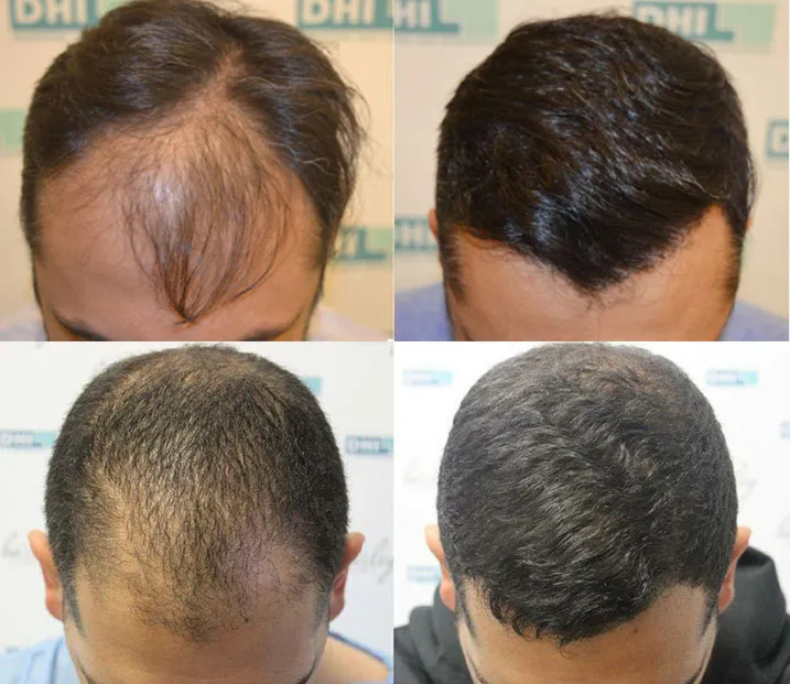 Hair Transplant Treatment in Dabri Mor Hair Transp...