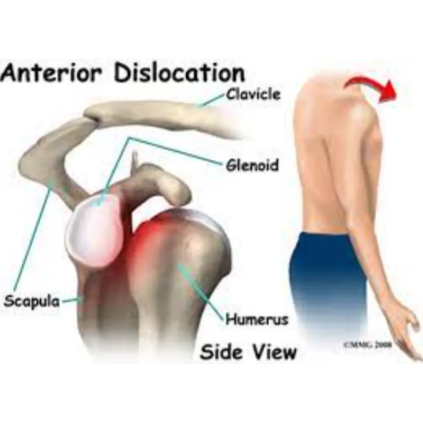 Advanced Solutions for Shoulder Dislocation and In...