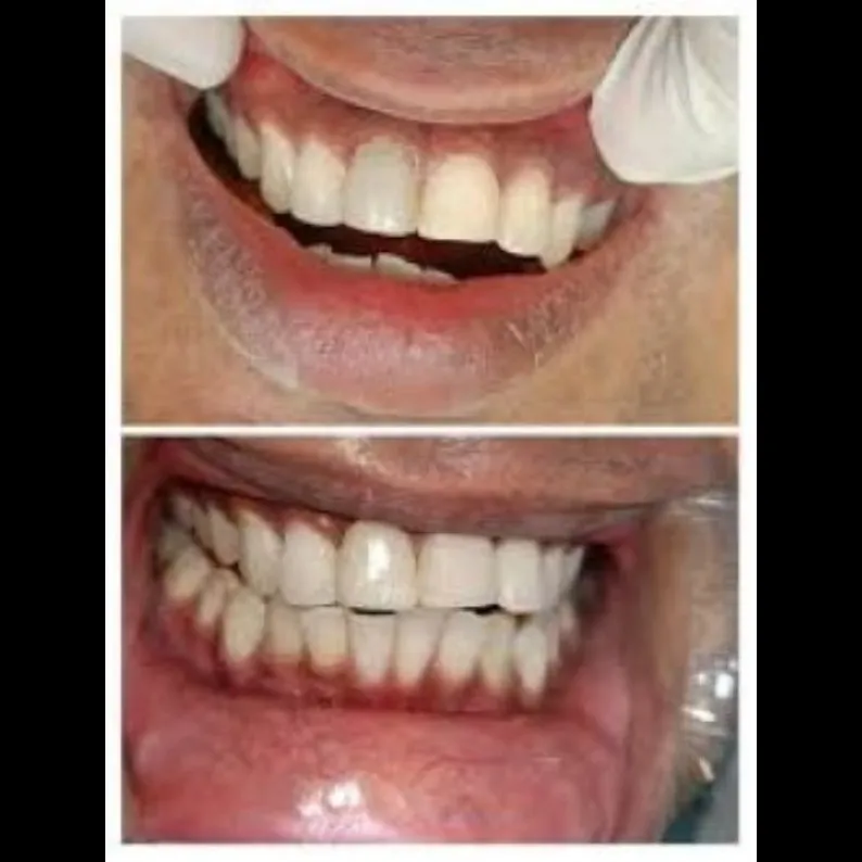 Dental Zirconia Crowns in Greater Noida West - Are...