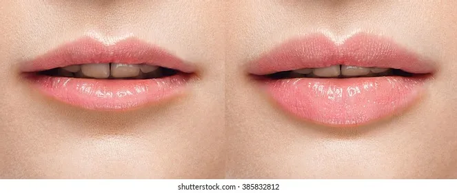 #Best Lip Filler Treatment in Delhi Lip Filler Tre...
