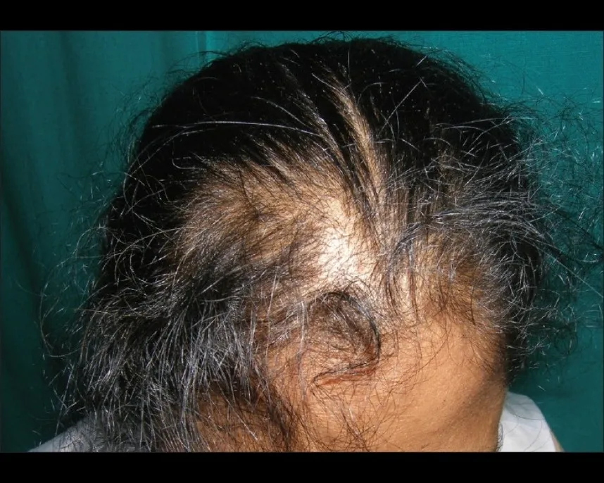 TALLOGEN EFFLUVIUM (HAIR FALL): UNDERSTANDING & TR...
