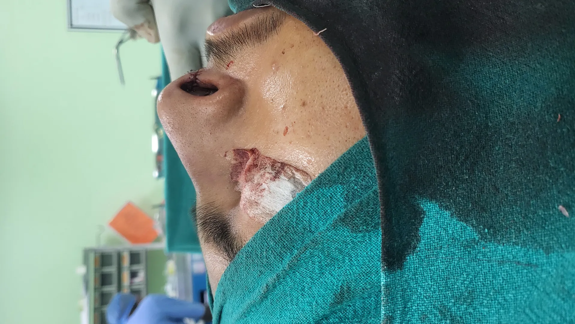 Best Rhinoplasty Surgeon in Delhi – @Dr. Saloni Si...