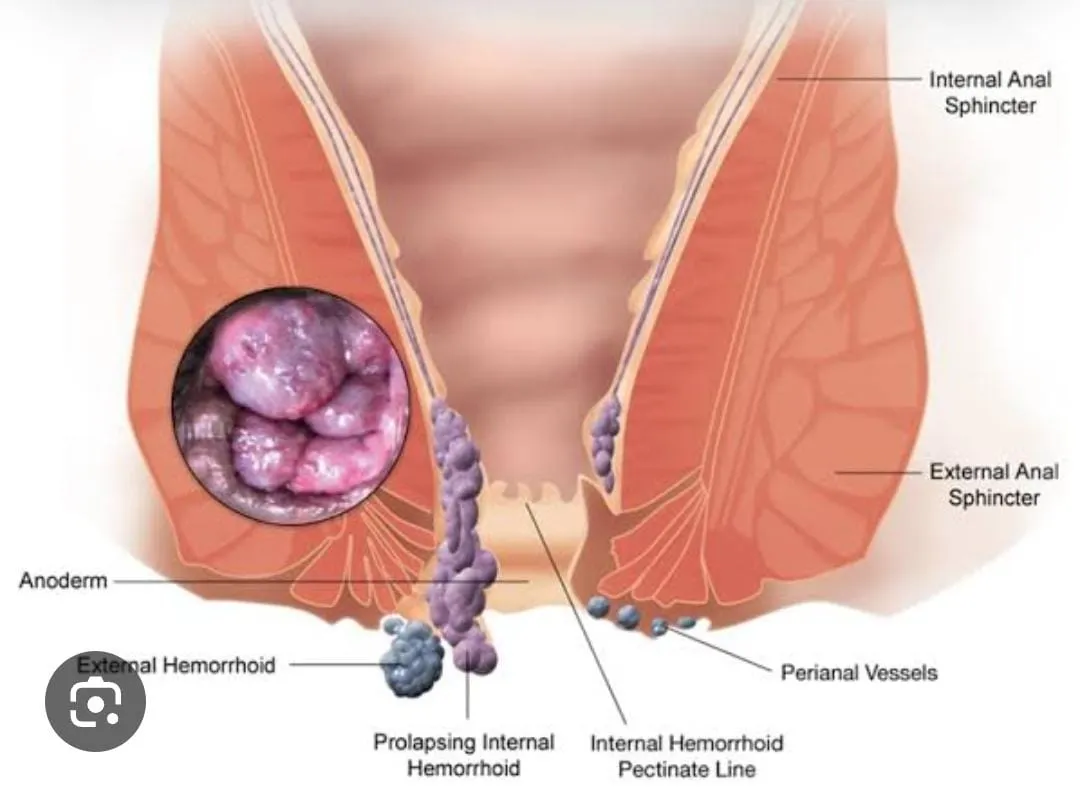 Hemorrhoids (Piles) : Conservative treatment sympt...