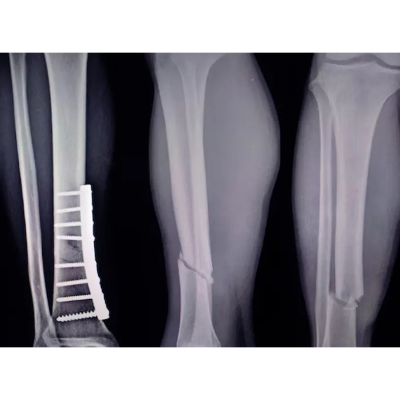 Fracture Fixation Surgery in Hennur: Healing Broke...