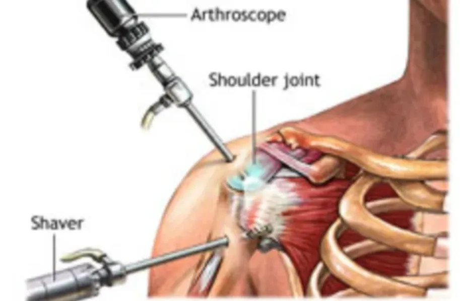 Bankart Shoulder Repair Surgery in Bangalore – Res...