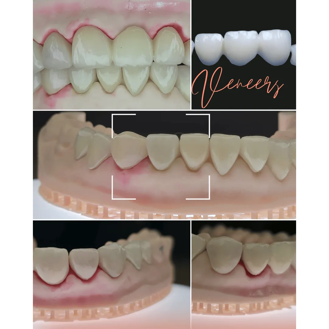 Title: Smile Makeover with Ultra-Natural Ceramic V...