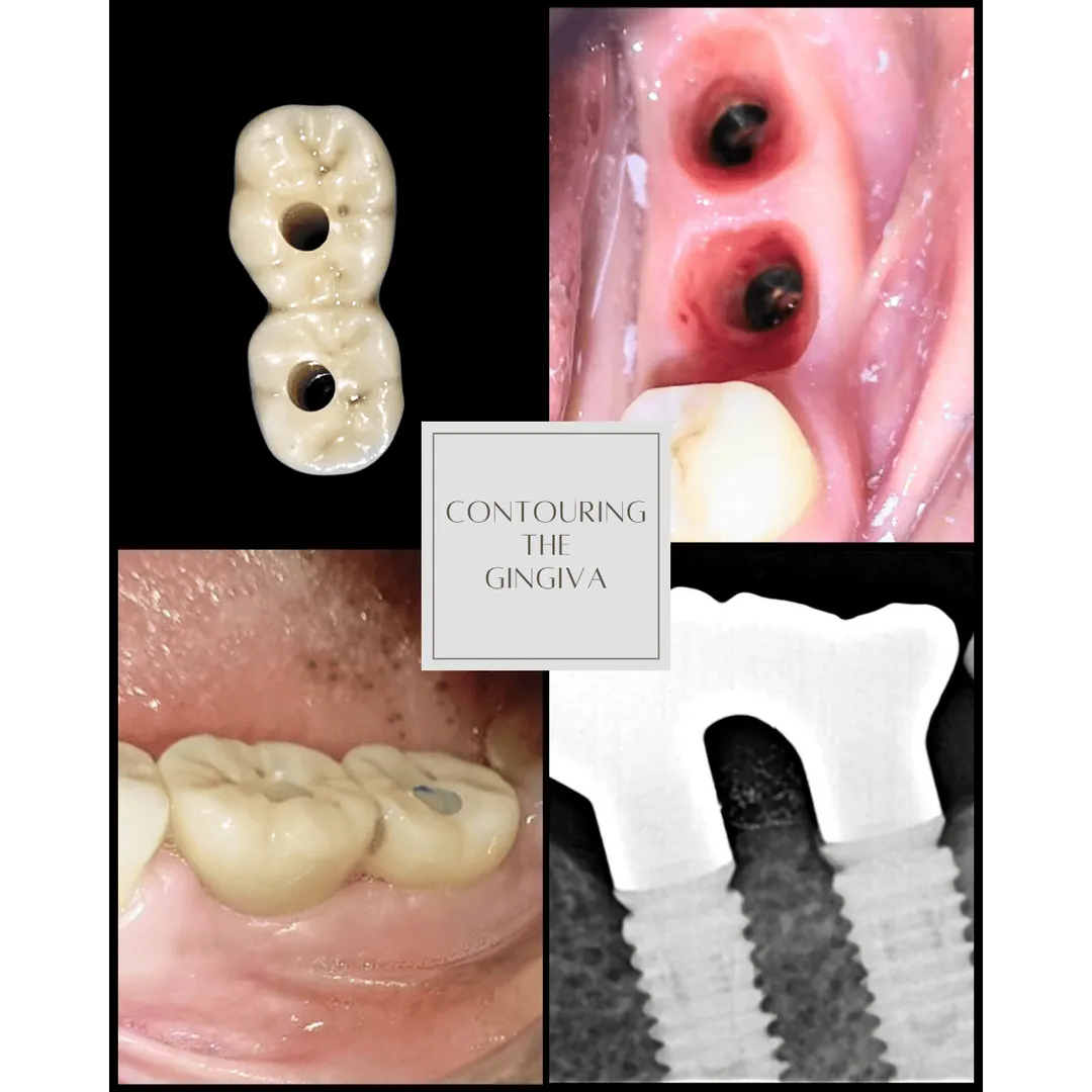 Contouring the Gingiva for Natural-Looking Dental ...