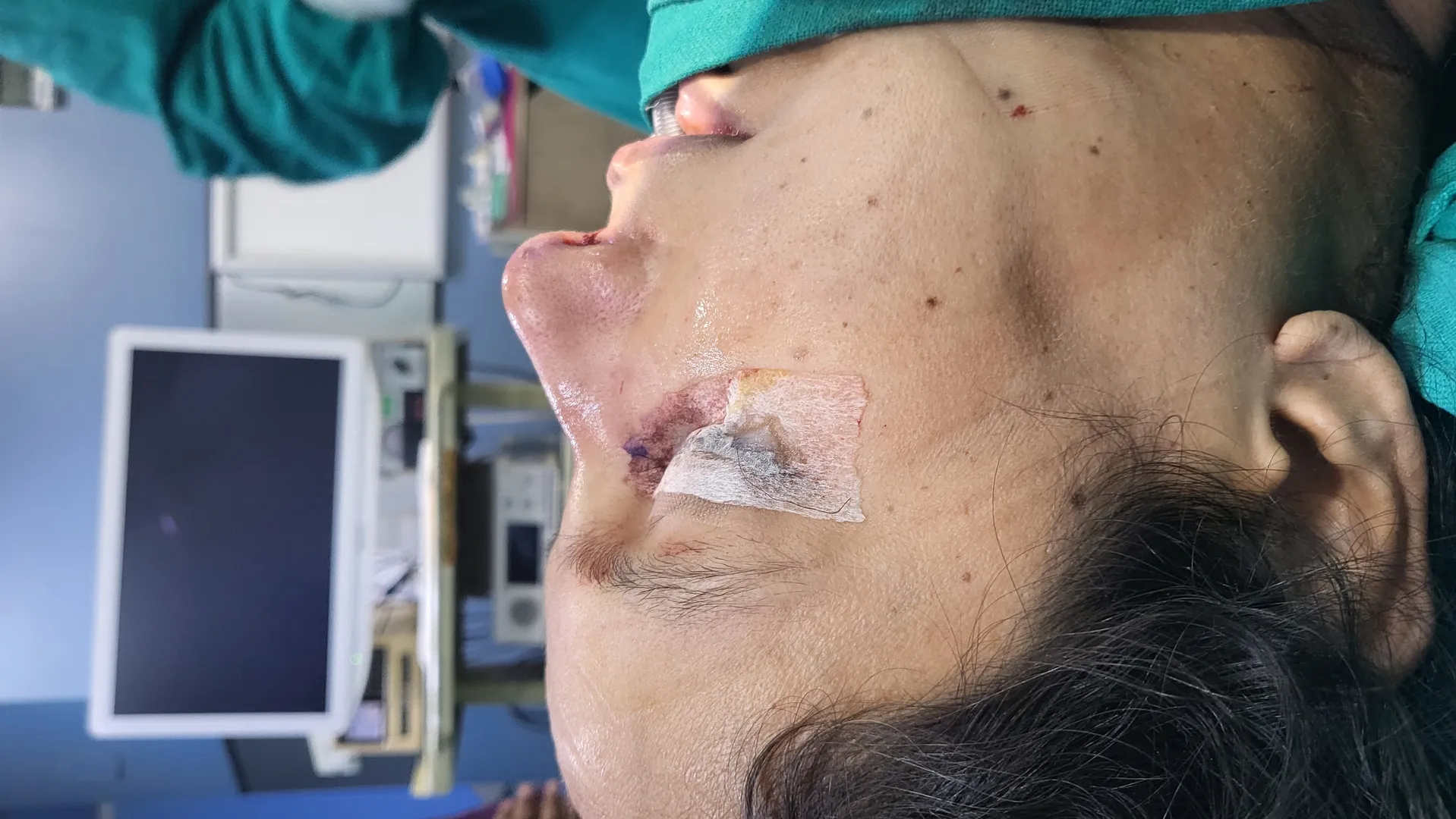 Affordable Rhinoplasty in Delhi, Dwarka, and Janak...