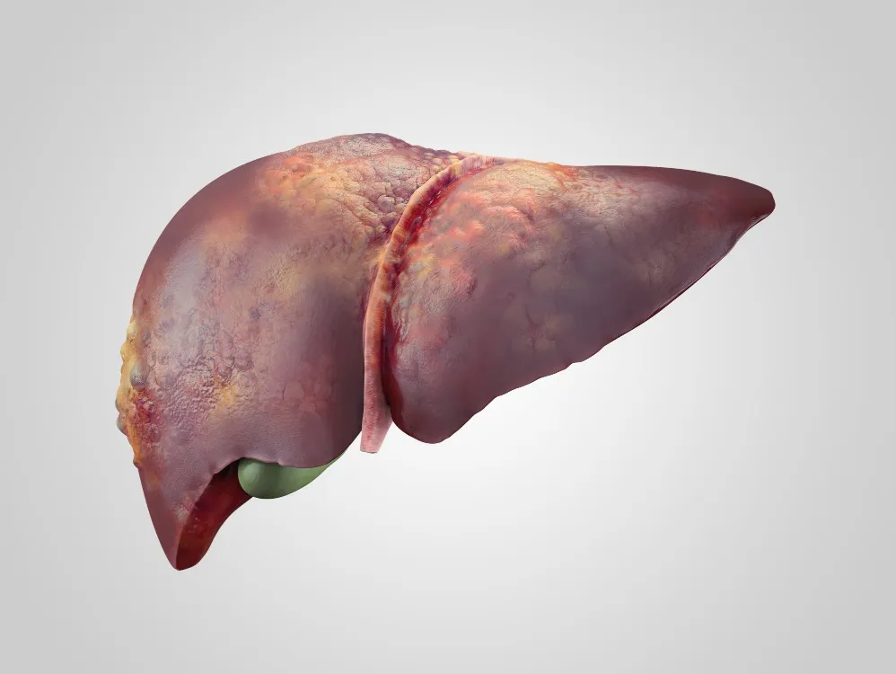 Obesity and Liver Disease – A Rising Risk in Mumba...