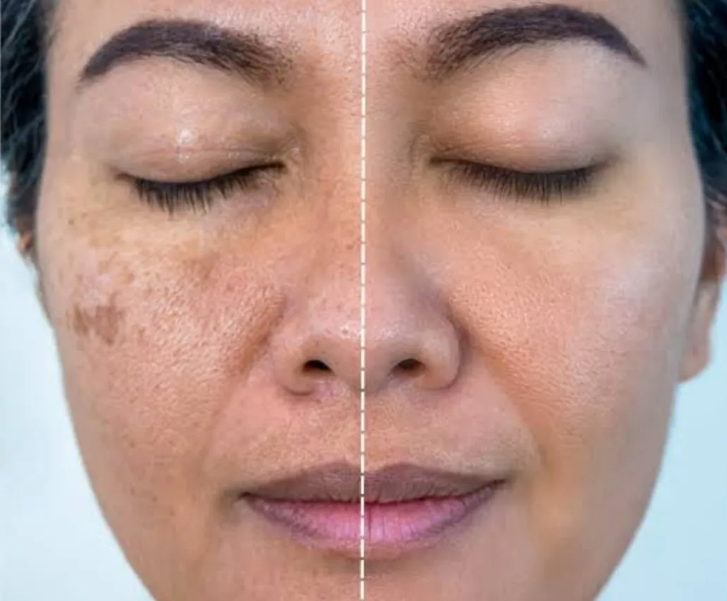 Best melasma centre in dwarka Best melasma centre ...
