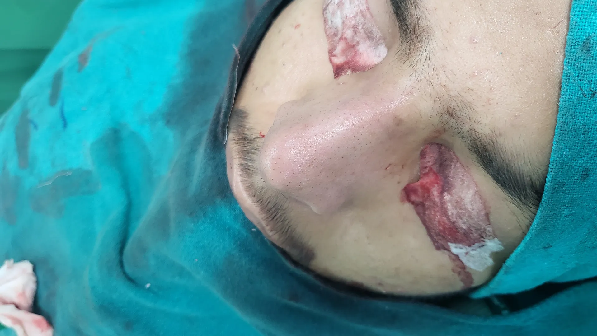 Nose Job Expert in Dwarka @ Aishanya Aesthetic Cen...