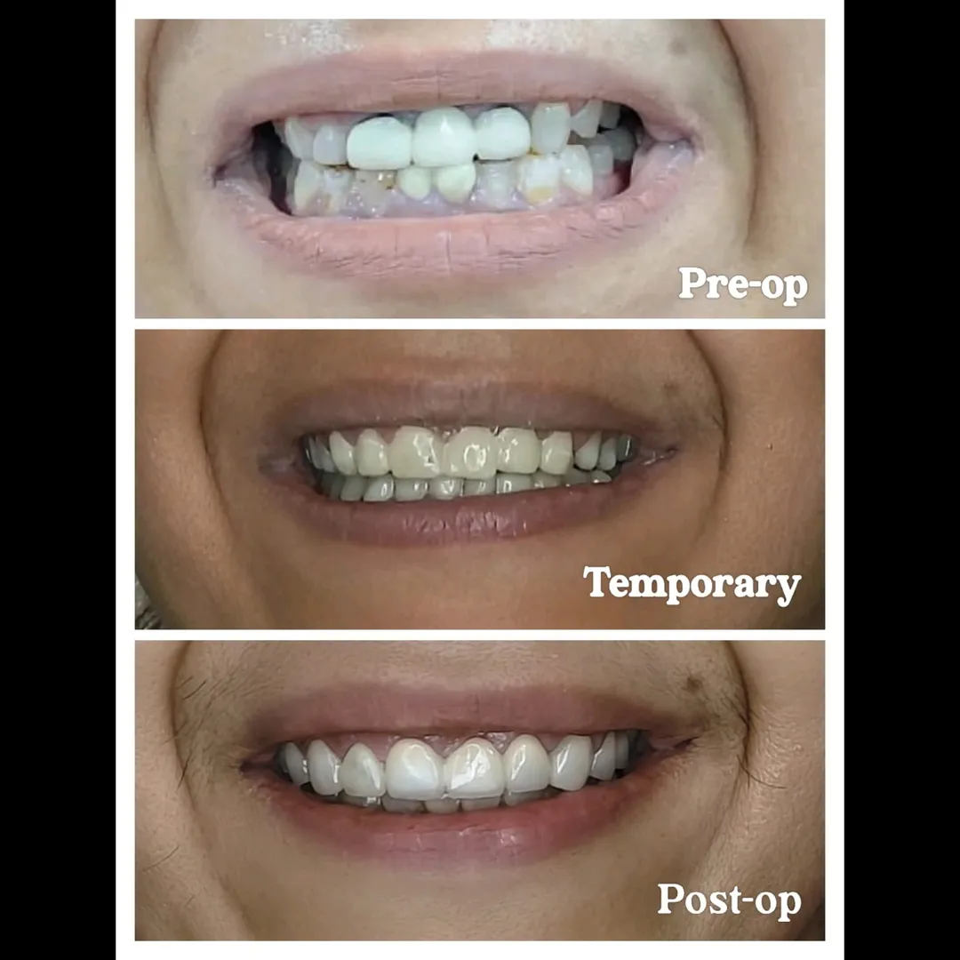 Smile Makeover with Veneers & Crowns: From Discolo...