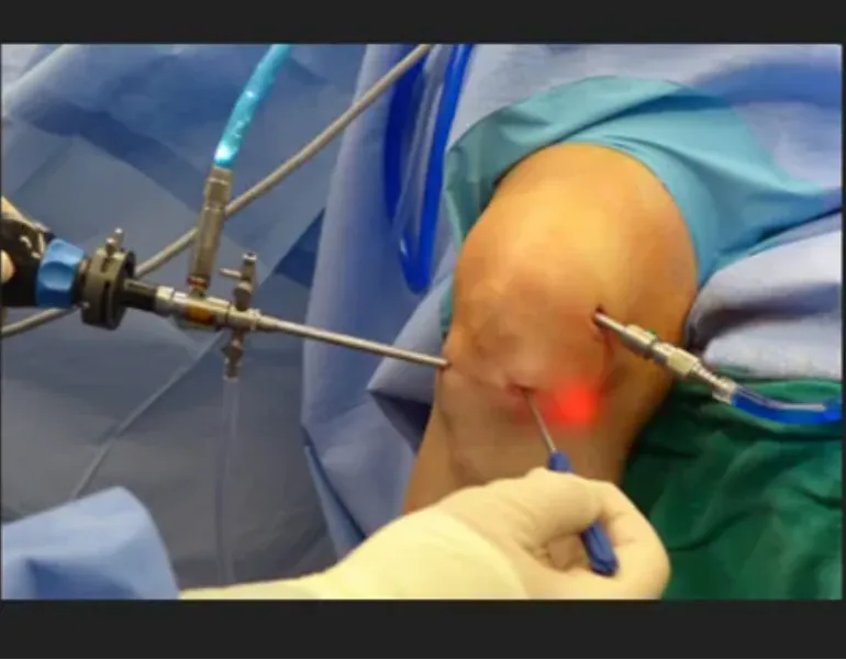 Meniscus Repair Surgeon in Nagpur – Restoring Knee...