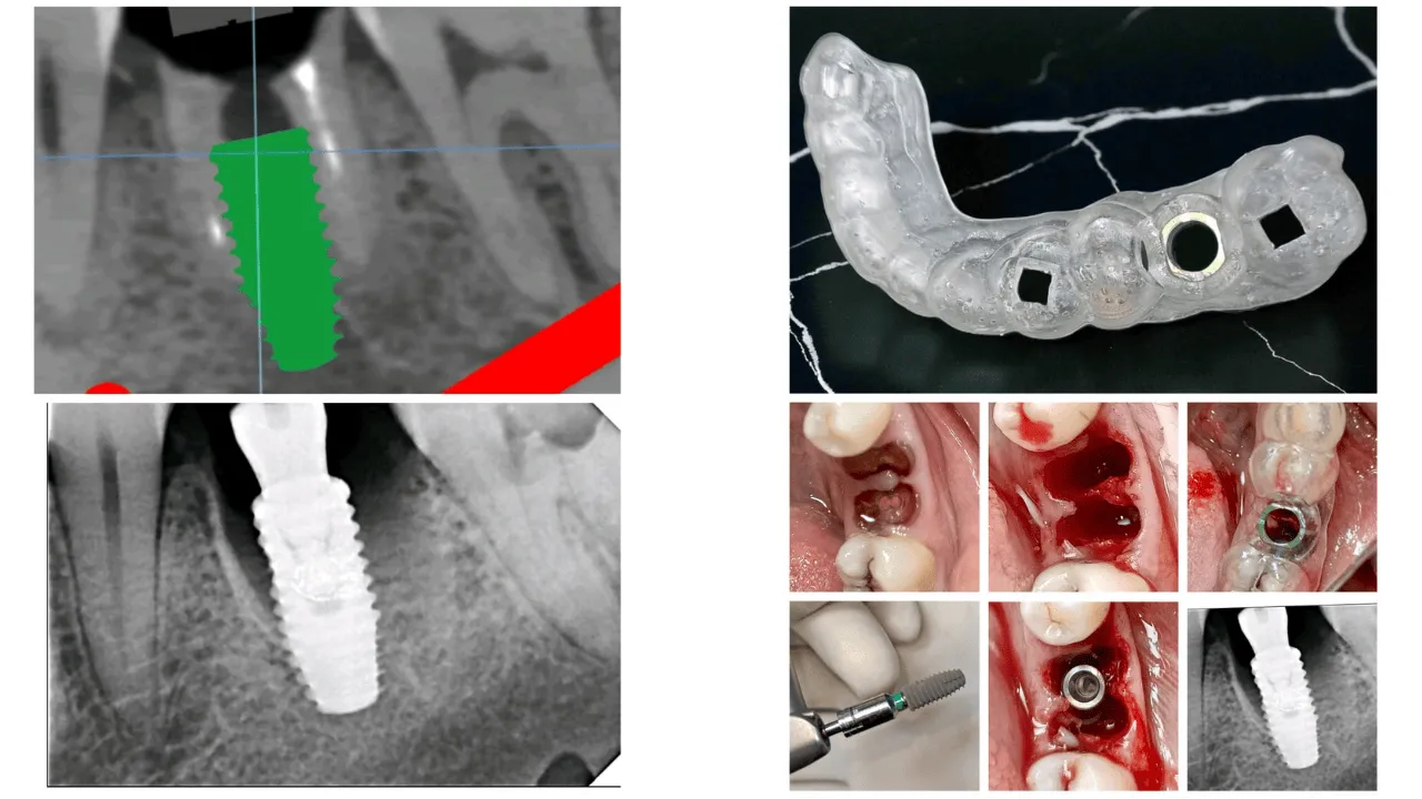 Guided Implant Surgery Using NeoBiotech Implants: ...