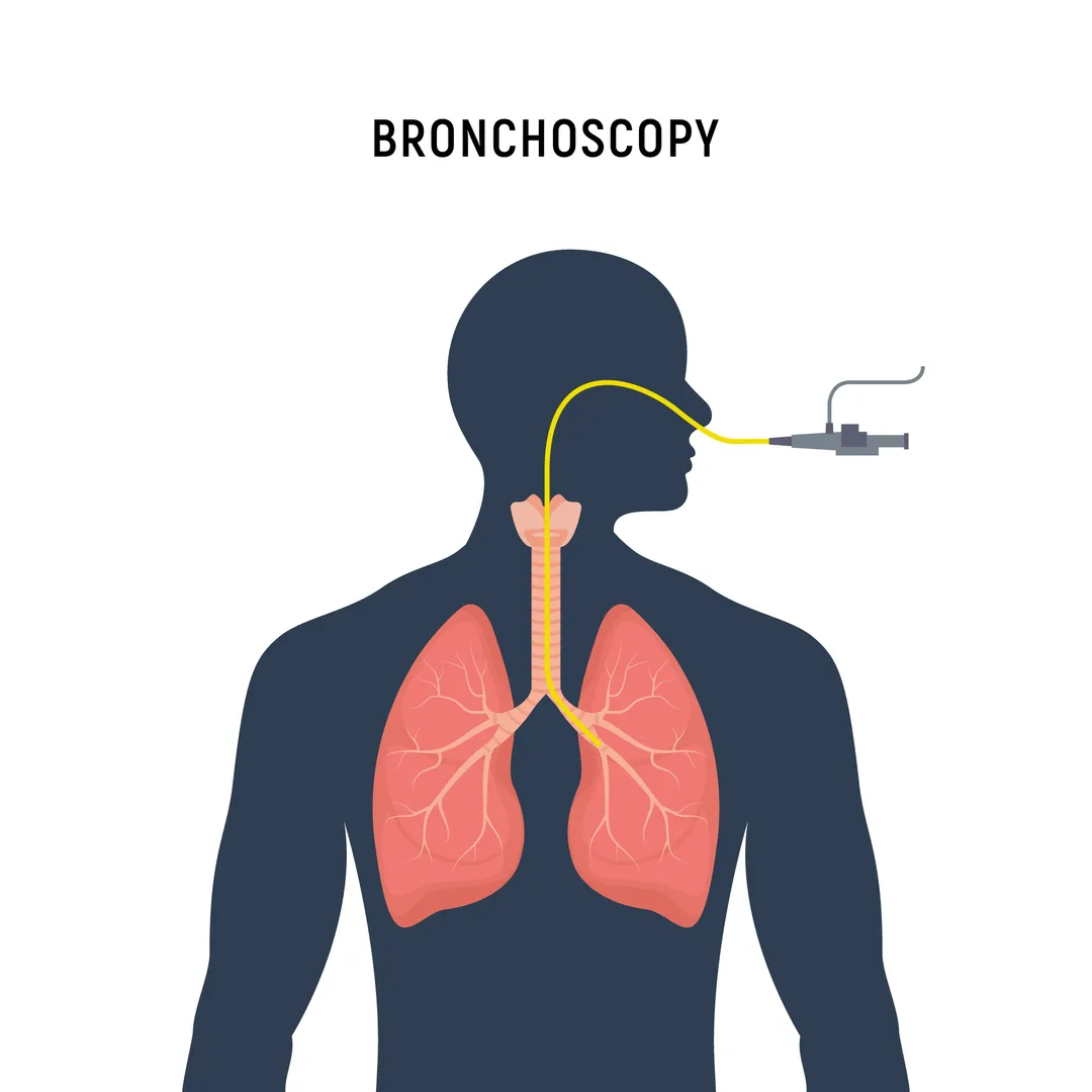 Bronchoscopy Procedure in Rajasthan for Lung Diagn...