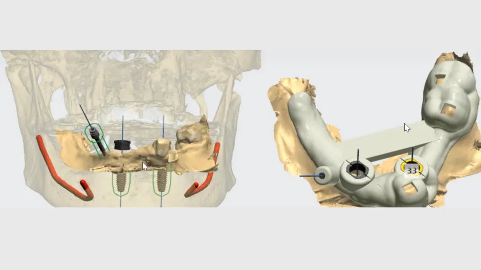 Precision-Driven Dentistry: Virtual Implant Planni...