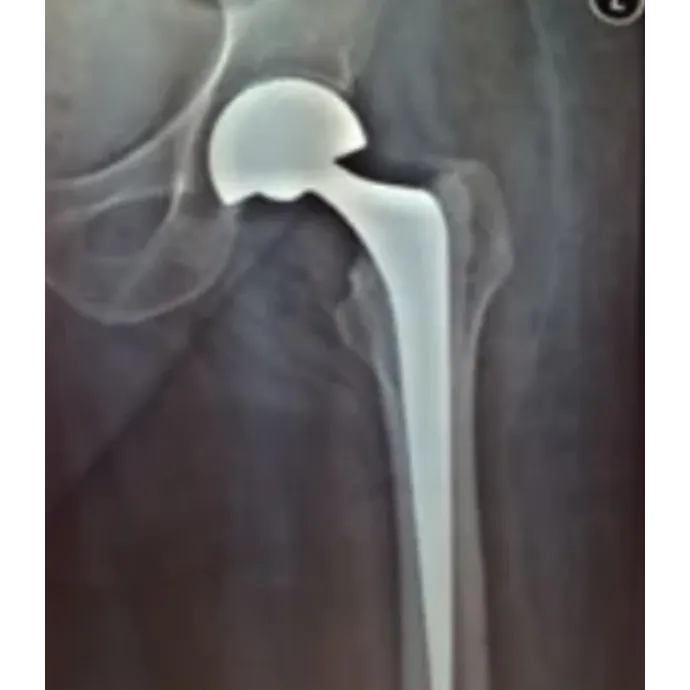 Hemiarthroplasty for Hip Pain in Yelahanka: A Part...