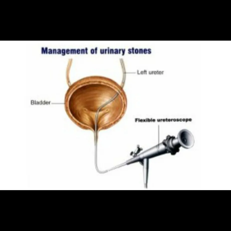 Laser Stone Treatment in Thane – Painless and Prec...