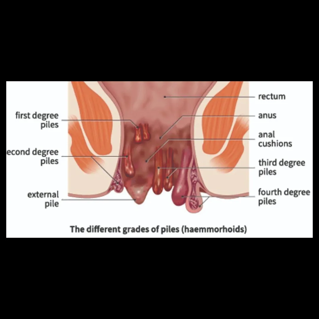 Best Piles treatment in Goregaon
Hemorrhoids (Pi...